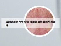 成都银康医院牛皮癣 成都银康银屑医院怎么样