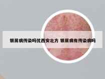 银屑病传染吗优西安北方 银屑病有传染病吗