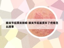 膝关节后窝皮肤癣 膝关节后面窝长了疙瘩怎么回事