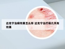 达克宁治癣效果怎么样 达克宁治疗癣几天有效果