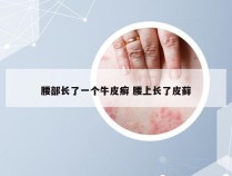 腰部长了一个牛皮癣 腰上长了皮藓