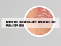 有银屑病可以刮砂拨火罐吗 有银屑病可以刮砂拨火罐吗视频