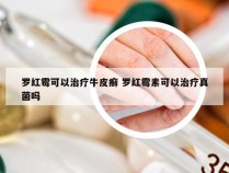 罗红霉可以治疗牛皮癣 罗红霉素可以治疗真菌吗