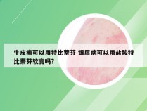 牛皮癣可以用特比萘芬 银屑病可以用盐酸特比萘芬软膏吗?