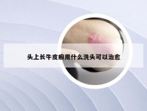 头上长牛皮癣用什么洗头可以治愈