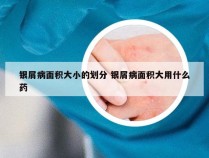 银屑病面积大小的划分 银屑病面积大用什么药