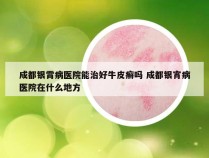 成都银霄病医院能治好牛皮癣吗 成都银宵病医院在什么地方