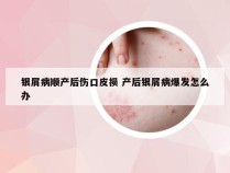 银屑病顺产后伤口皮损 产后银屑病爆发怎么办