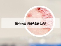 银xiao病 银消病是什么病?