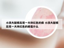 小孩大腿根出现一大块红色的癣 小孩大腿根出现一大块红色的癣是什么