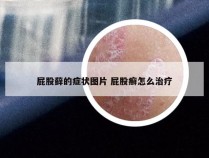 屁股藓的症状图片 屁股癣怎么治疗