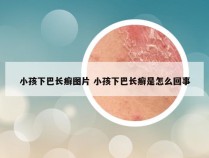 小孩下巴长癣图片 小孩下巴长癣是怎么回事