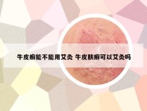 牛皮癣能不能用艾灸 牛皮肤癣可以艾灸吗