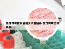 慢性斑块性银屑病受试者招募 慢性斑块型银屑病