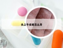 头上牛皮癣怎么弄