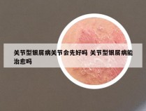 关节型银屑病关节会先好吗 关节型银屑病能治愈吗