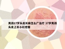 男孩17岁头皮长癣怎么广治疗 17岁男孩头皮上长小红疙瘩