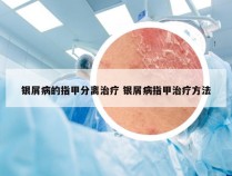 银屑病的指甲分离治疗 银屑病指甲治疗方法