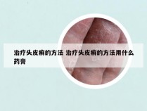 治疗头皮癣的方法 治疗头皮癣的方法用什么药膏