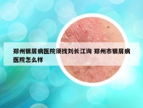 郑州银屑病医院须找刘长江询 郑州市银屑病医院怎么样