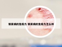 银屑病的免疫力 银屑病的免疫力怎么样