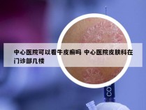 中心医院可以看牛皮癣吗 中心医院皮肤科在门诊部几楼