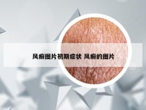 风癣图片初期症状 风癣的图片