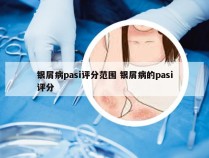 银屑病pasi评分范围 银屑病的pasi评分