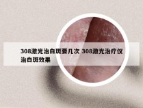 308激光治白斑要几次 308激光治疗仪治白斑效果