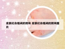 皮肤红白相间的斑块 皮肤红白相间的斑块图片