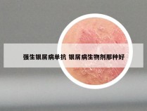 强生银屑病单抗 银屑病生物剂那种好