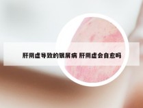 肝阴虚导致的银屑病 肝阴虚会自愈吗