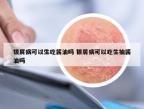 银屑病可以生吃酱油吗 银屑病可以吃生抽酱油吗