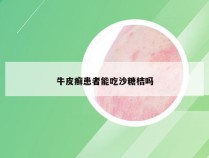 牛皮癣患者能吃沙糖桔吗