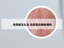 白斑疯怎么治 白斑是白颠疯病吗