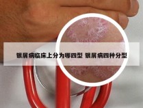 银屑病临床上分为哪四型 银屑病四种分型