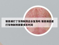 银屑病打了生物制剂还会复发吗 银屑病患者打生物制剂需要多长时间