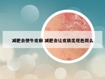 减肥会使牛皮癣 减肥会让皮肤出现色斑么