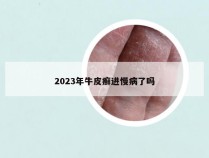 2023年牛皮癣进慢病了吗