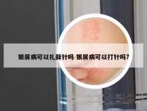 银屑病可以扎藓针吗 银屑病可以打针吗?