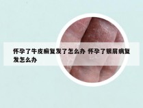 怀孕了牛皮癣复发了怎么办 怀孕了银屑病复发怎么办