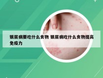 银屑病要吃什么食物 银屑病吃什么食物提高免疫力