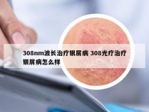 308nm波长治疗银屑病 308光疗治疗银屑病怎么样