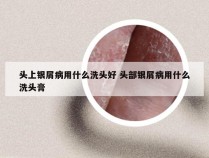 头上银屑病用什么洗头好 头部银屑病用什么洗头膏