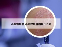 小型银屑病 小面积银屑病用什么药