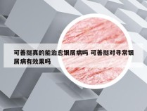 可善挺真的能治愈银屑病吗 可善挺对寻常银屑病有效果吗