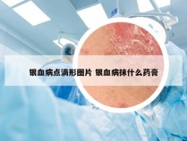 银血病点滴形图片 银血病抹什么药膏