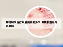 生物制剂治疗银屑病需要多久 生物制剂冶疗银屑病