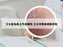 三七能治身上牛皮癣吗 三七对银屑病有好处