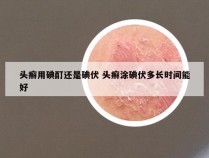 头癣用碘酊还是碘伏 头癣涂碘伏多长时间能好